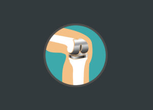 5 Insights Into the Rising Role of Joint Replacement in Workers’ Compensation